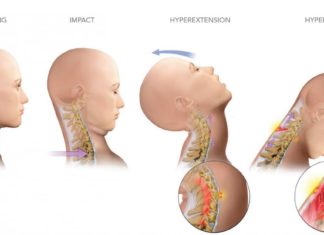 What is Whiplash? What is whiplash