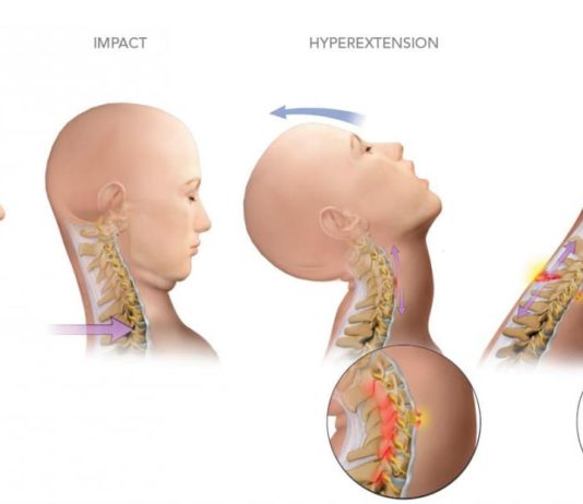 What is Whiplash? What is whiplash